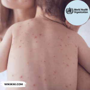 Measles Cases in Europe