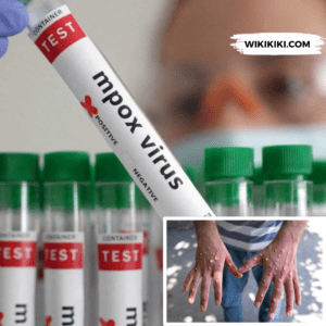 Latest Mpox News, Vaccination Updates and More – November 2024